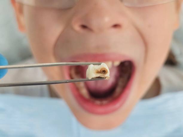 Best Knocked-Out Tooth Emergency  in Cedar Grove, FL